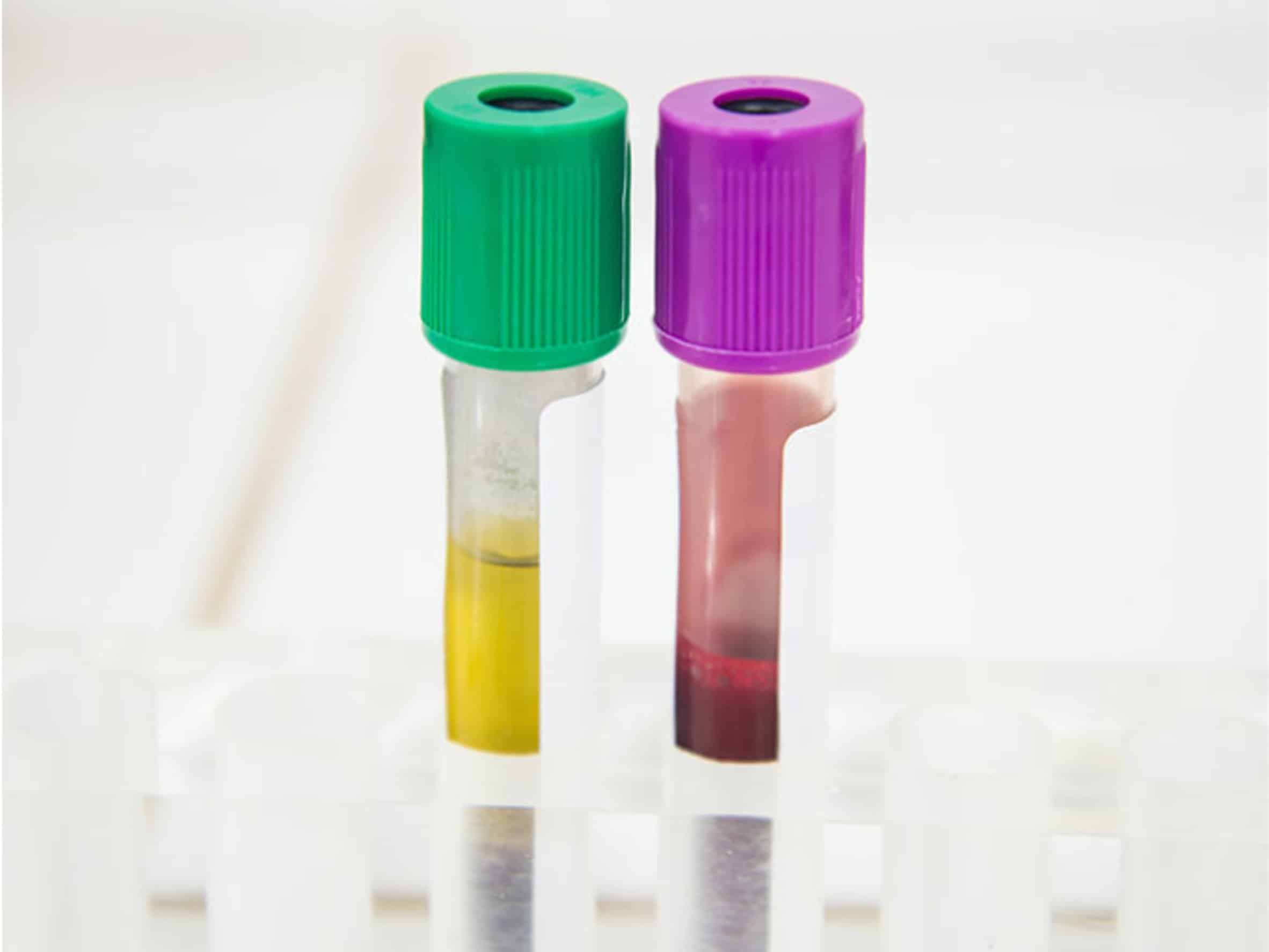 PRP-Eigenbluttherapie PRP-Eigenbluttherapie