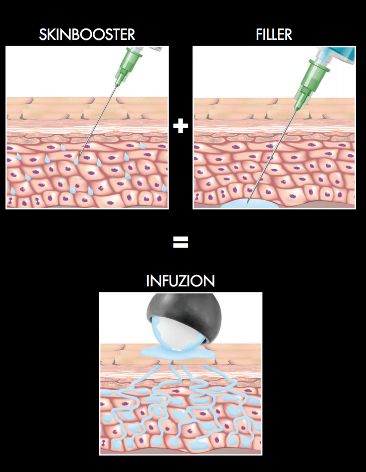 Vorteile Infuzion