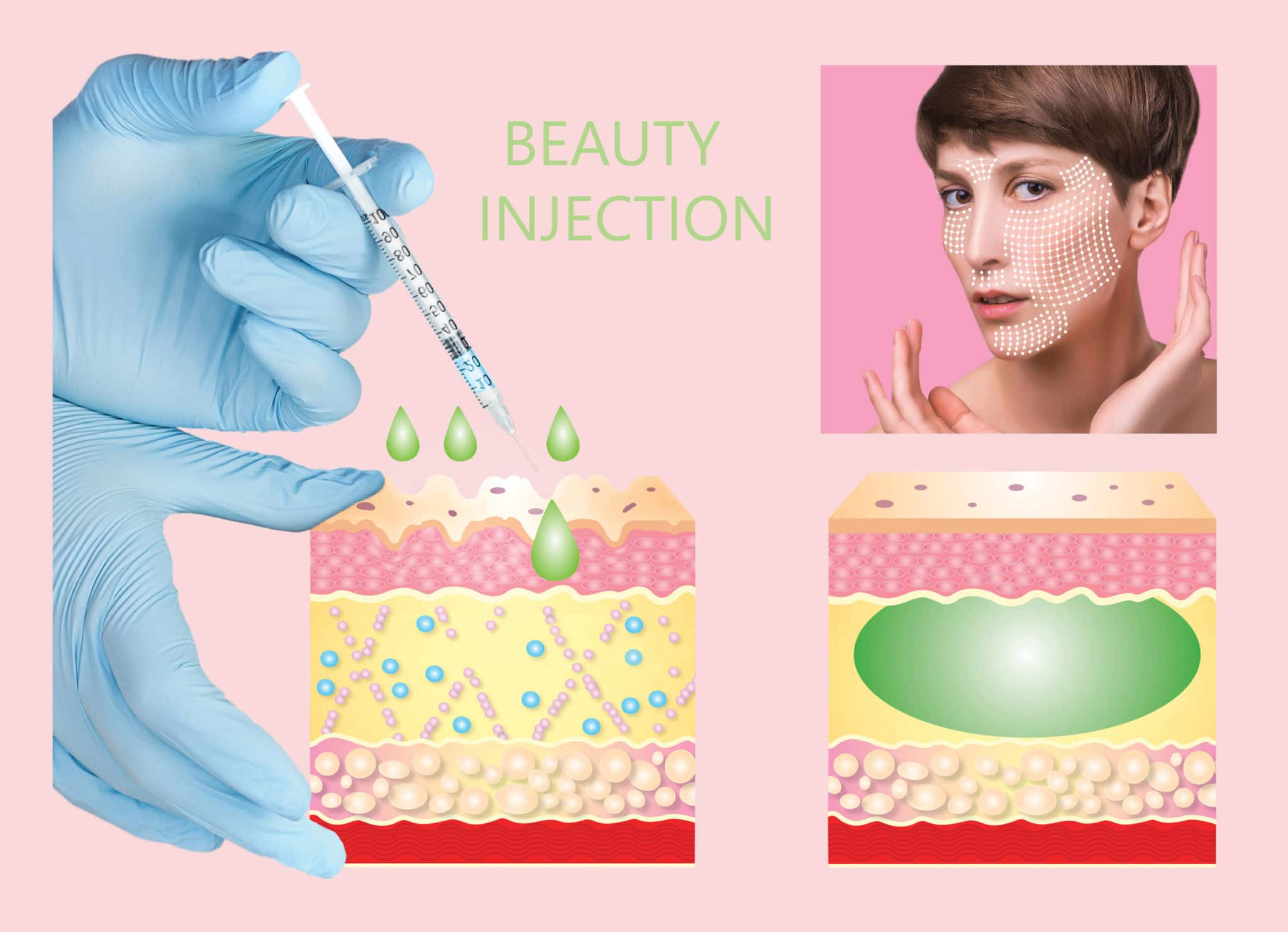 Cosmetic filler or dermal fillers